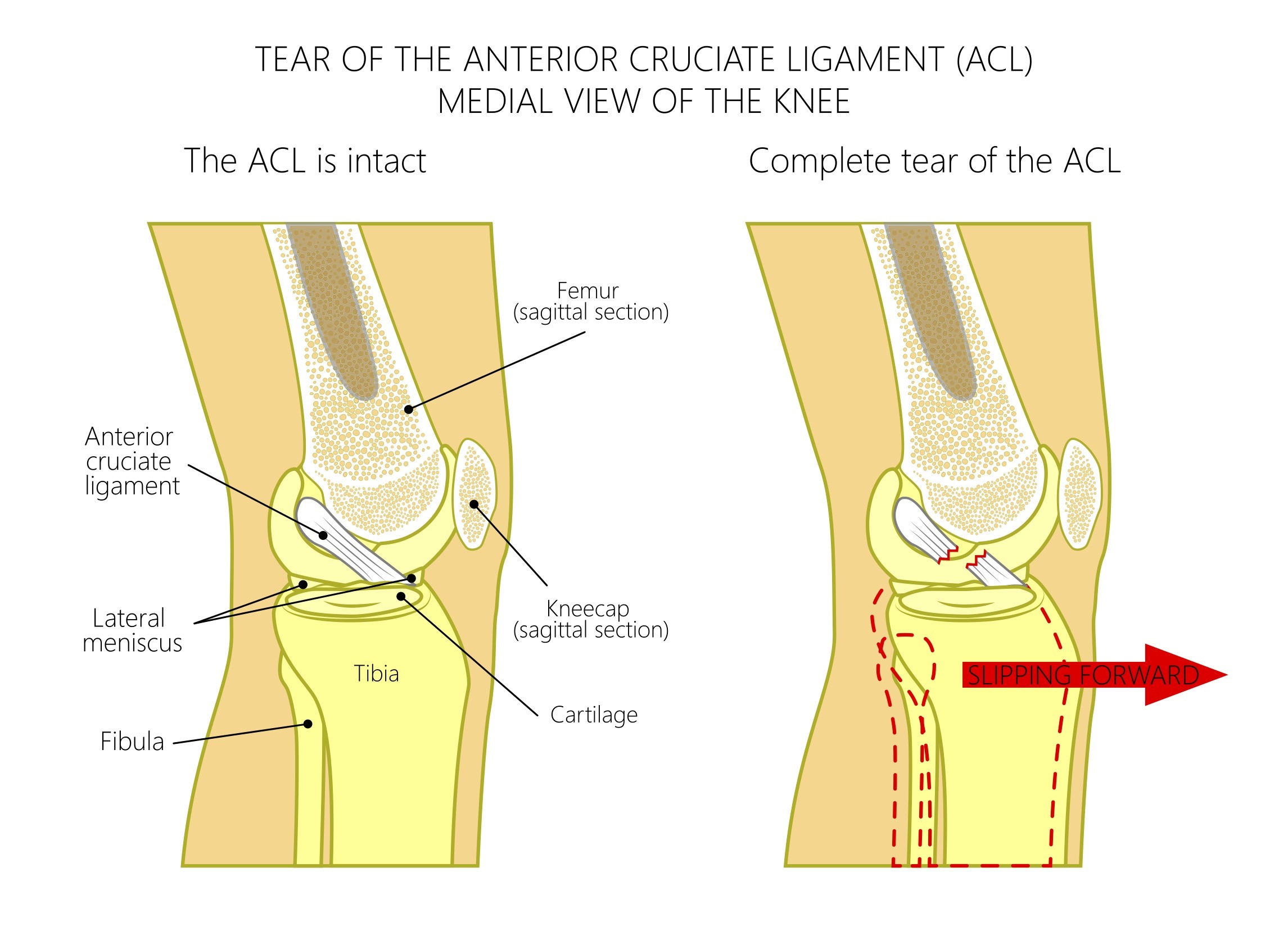 ACL Injuries - Austin Chen MD