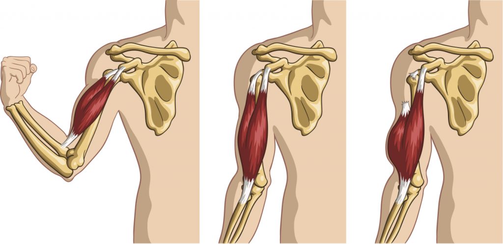 bicep-tendon-tears-and-tendonitis-austin-chen-md