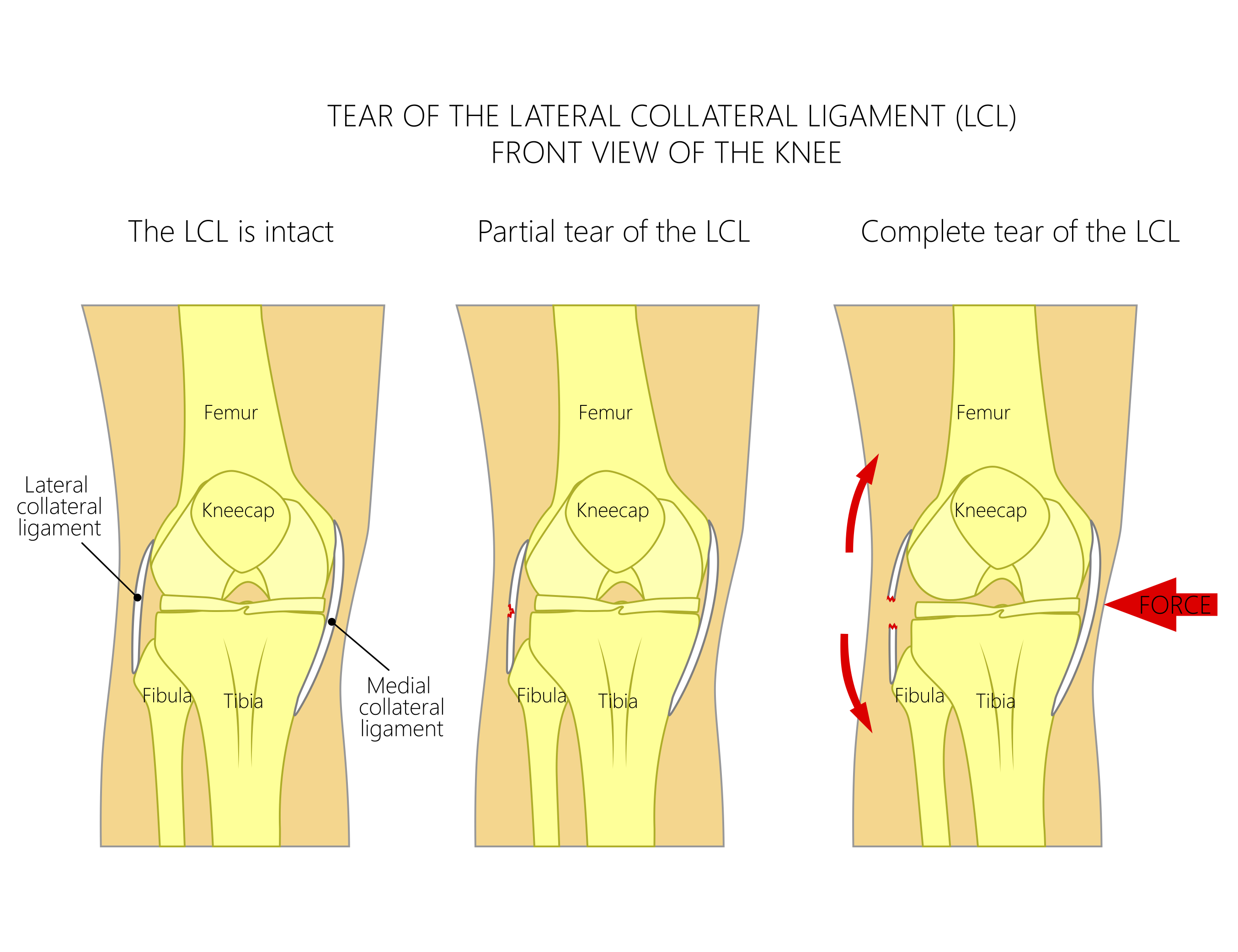 LCL Injury Lateral Collateral Ligament Injury Treatment in Boulder