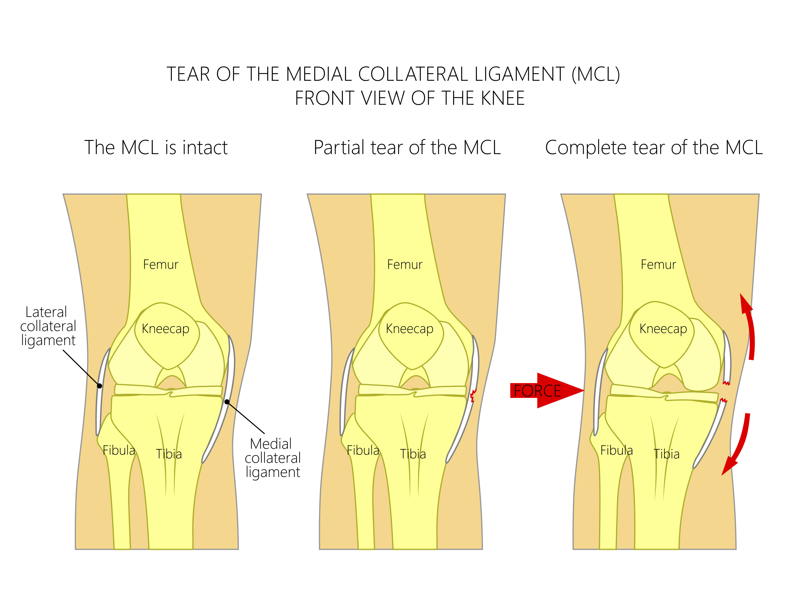 MCL Injury Treatment Medial Collateral Ligament Injury Surgery in