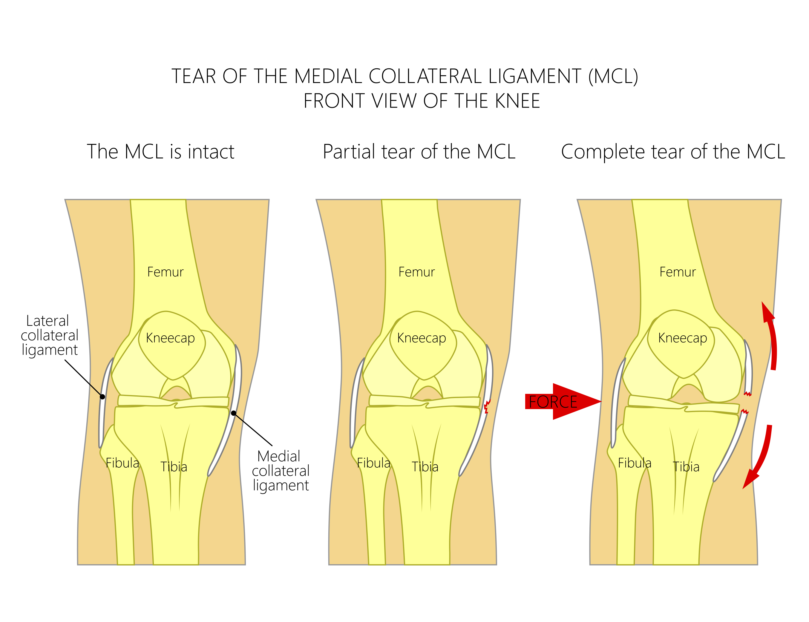 Acl And Mcl Surgery