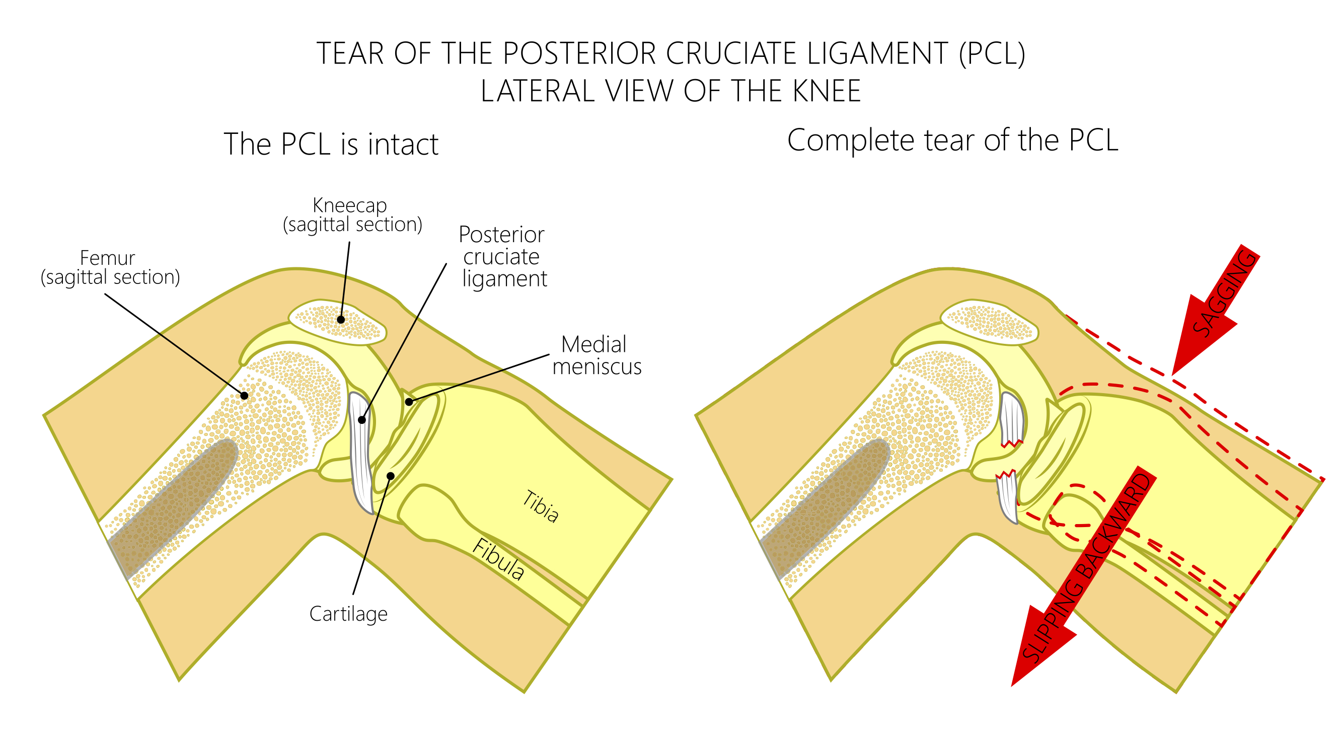 MCL Injury Treatment, Medial Collateral Ligament Injury Surgery in  Boulder, CO