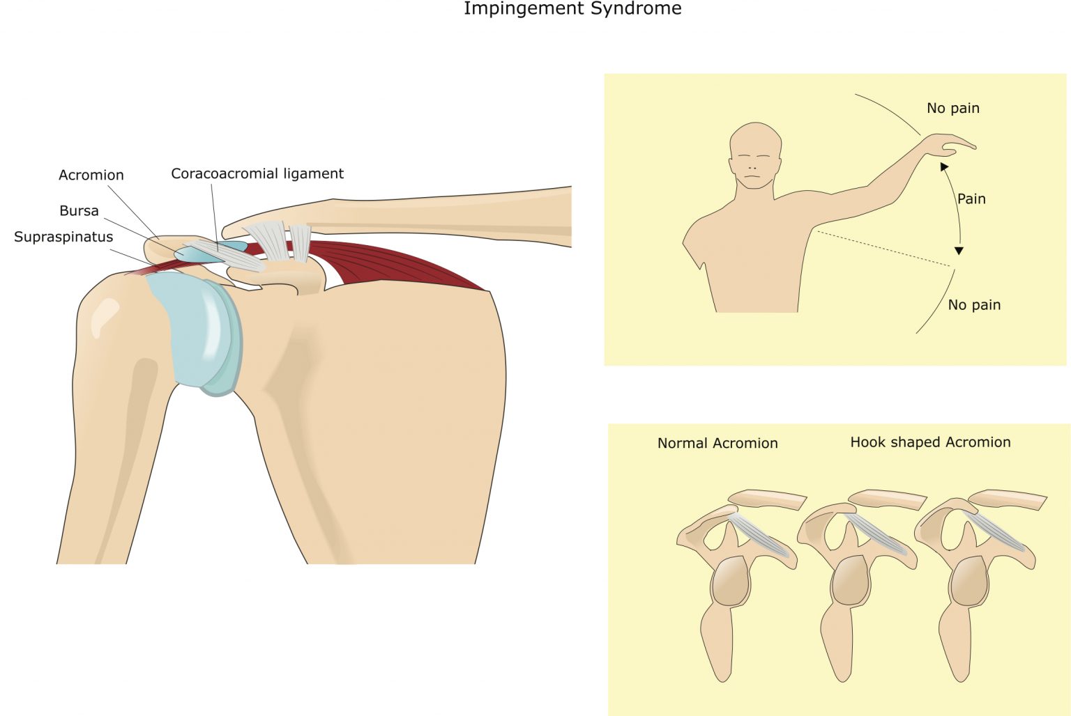 Shoulder Impingement - Austin Chen MD